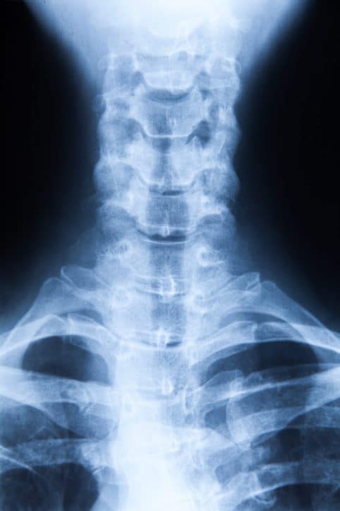 Virginia strangulation defense- X-ray image of neck area